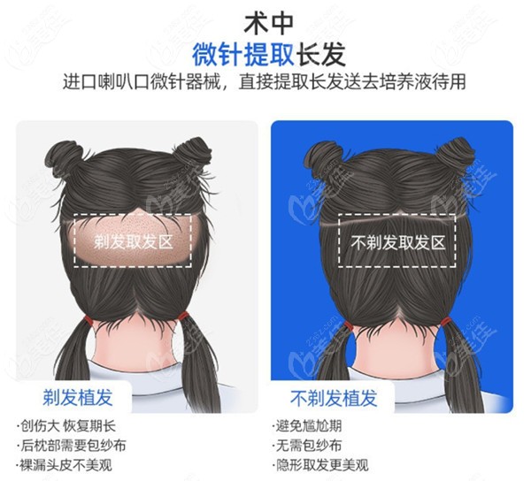 南京碧莲盛的不剃发植发技术