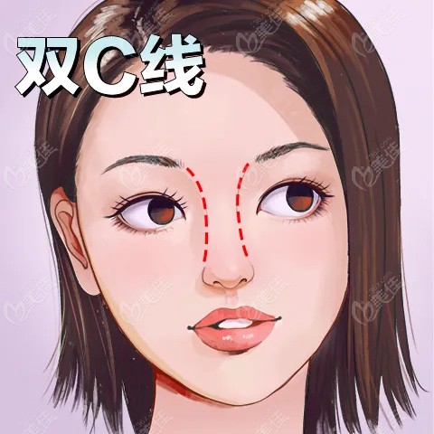 潘峰医生做的BSK隆鼻术后鼻型更自然m.236z.com