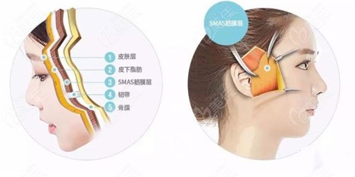 smas筋膜層提升手術剛做完照片236z.com