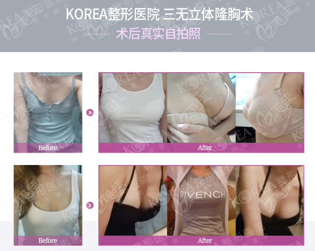 韩国korea整形医院隆胸术前后对比