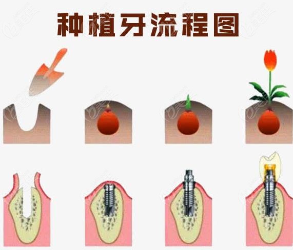 巴中白玉口腔种植牙技术怎么样 美@佳网