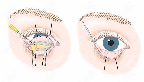 宋桂霞做的眼袋修复技术图www.236z.com