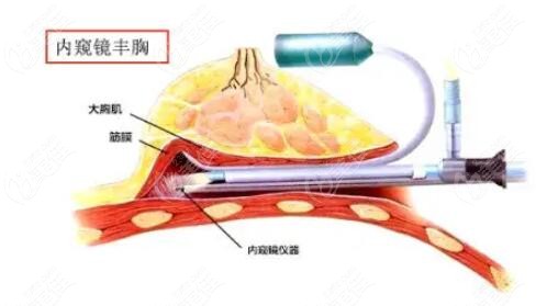 袁继龙医生的隆胸技术优势m.236z.com