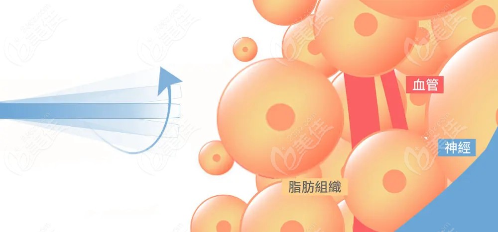 哈尔滨艺星整形吸脂技术图