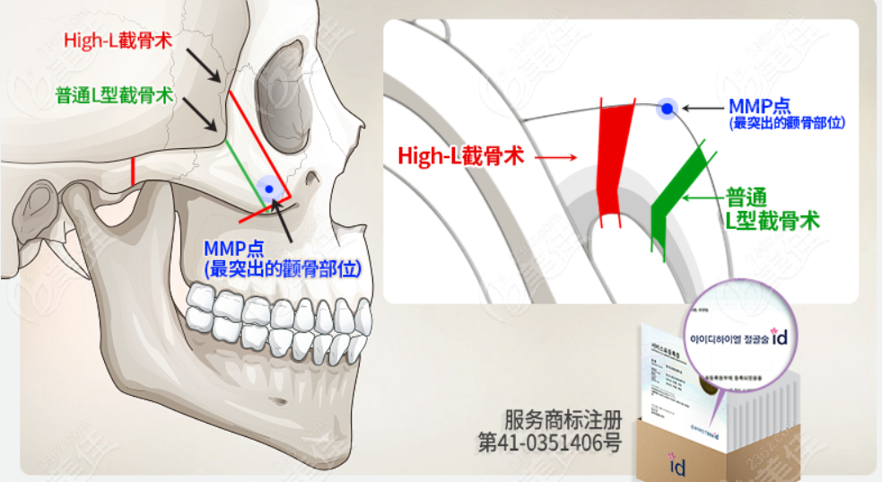韓國ID醫(yī)院李知赫醫(yī)生磨骨后顴骨寬度縮窄明顯
