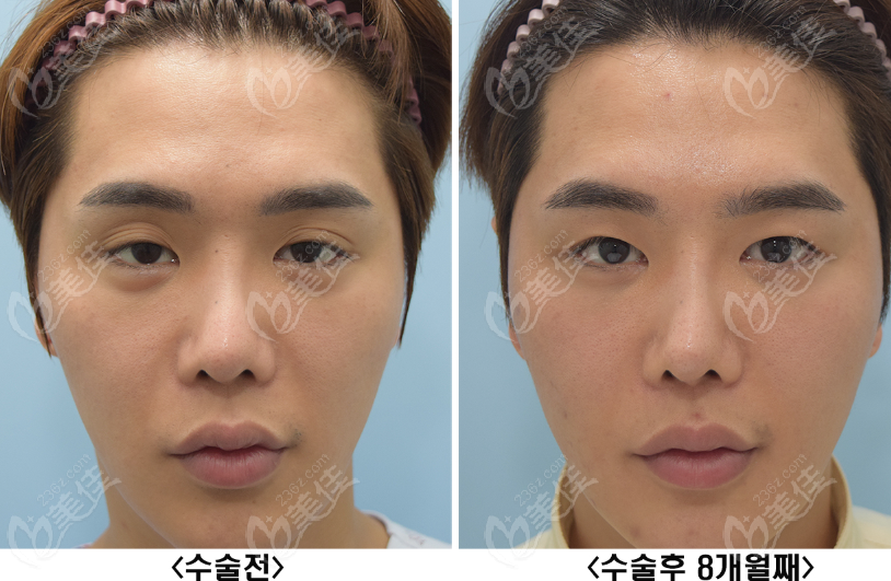 韩国来丽医院双眼皮改单眼皮术前后对比图