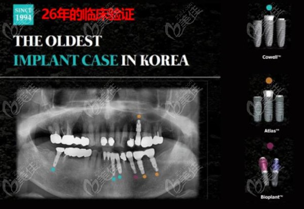 韩国柯威尔种植体怎么样