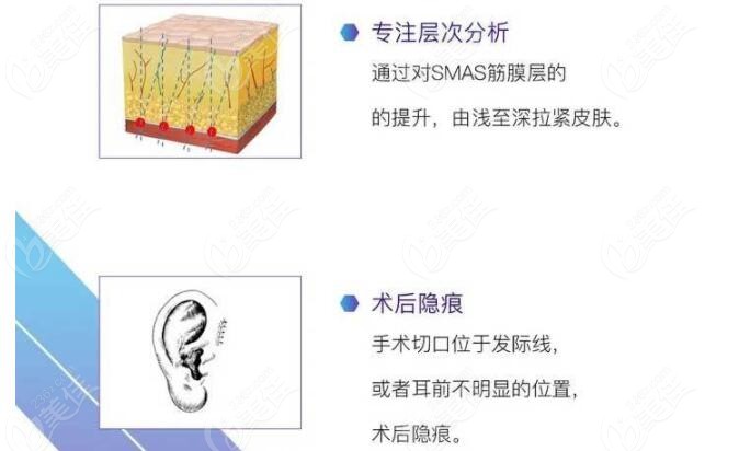王志军医生做面部拉皮手术的原理图www.236z.com