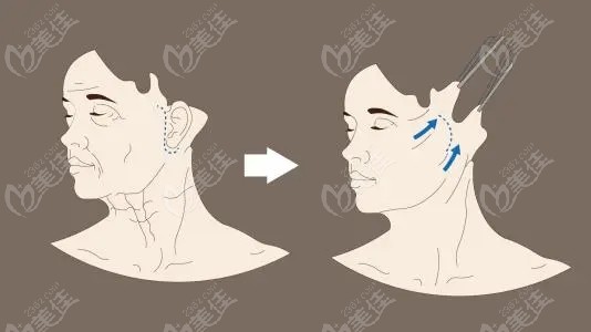 王焕医生做小切口拉皮的原理图