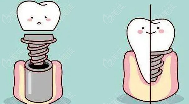 钦州粤桂时代口腔种植牙价格表m.236z.com