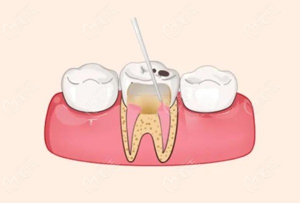 牙髓治疗和根管治疗是不一样的