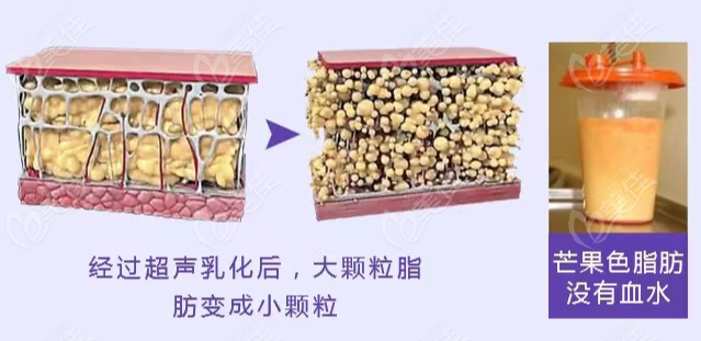 成都华生铂悦整形超脂塑吸脂多少钱