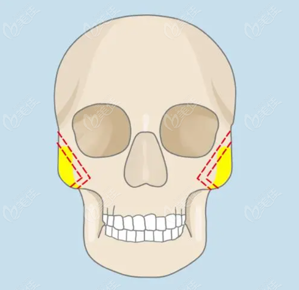 颧骨内推一年内苹果肌下垂怎么办