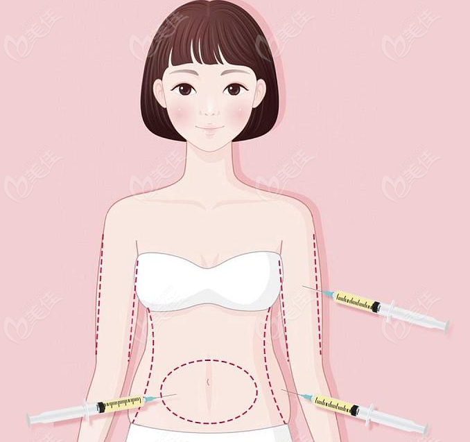 成都华生铂悦和<!--<i data=20240703-sp></i>-->吸脂哪家强 美@佳网