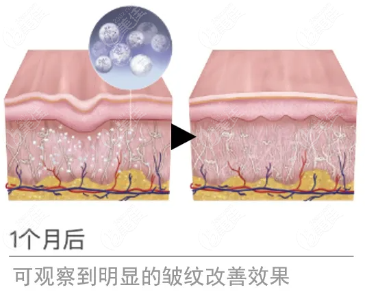 艾维岚针注射后一个月除皱疗效明显