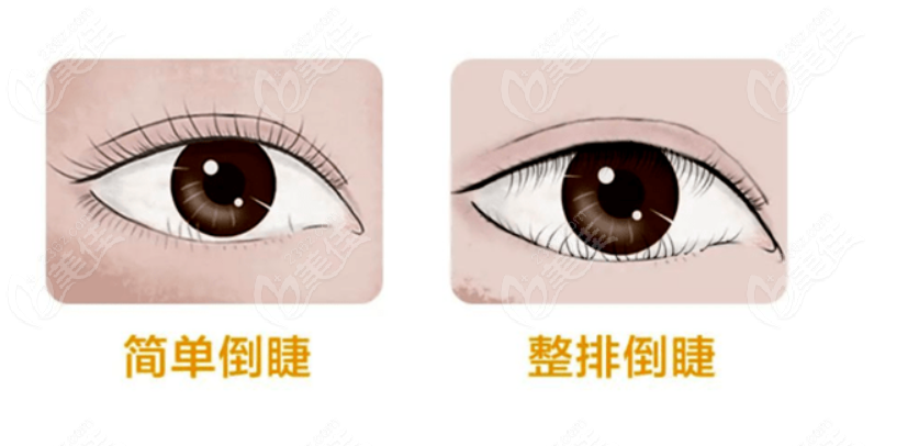 眼睑内翻倒睫手术怎么做