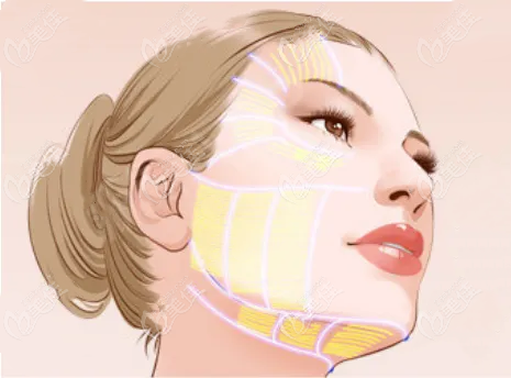 西寧美萊馨怡王鈉做面部提升手術