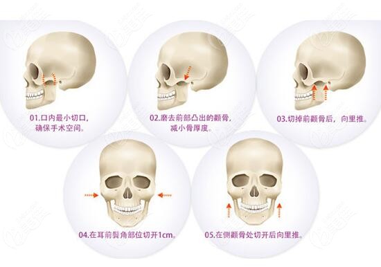削颧骨的后遗症有哪些
