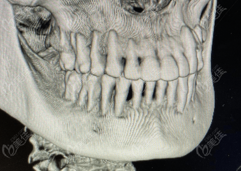 牙槽骨高度和宽度多少可以做种植牙