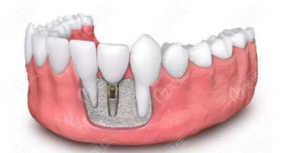 牙槽骨宽度不够怎么种植www.236z.com
