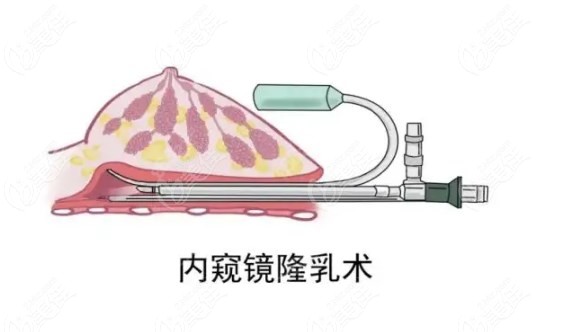 广州家庭医生隆胸技术好