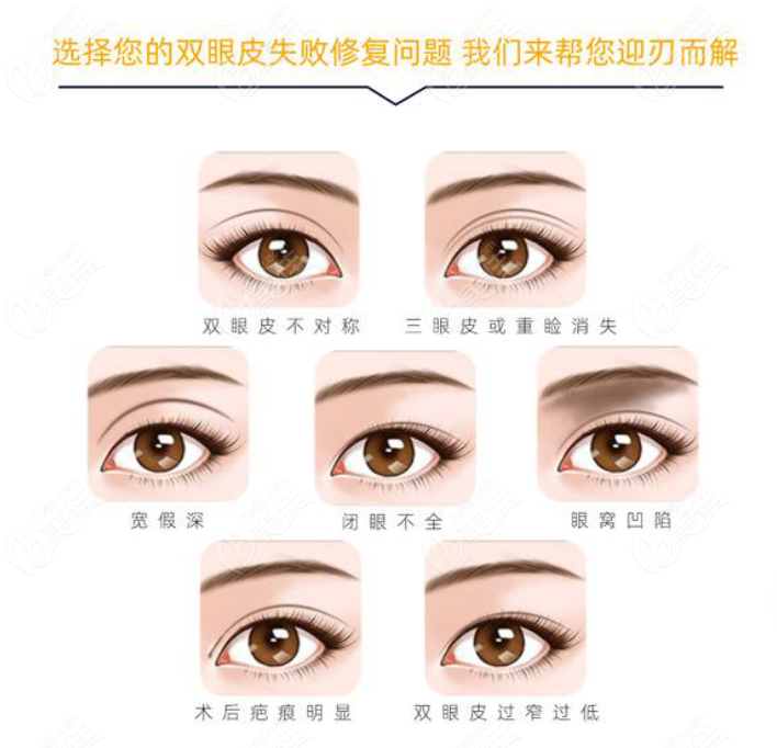 上海玫瑰医院各种双眼皮失败症状都能修复
