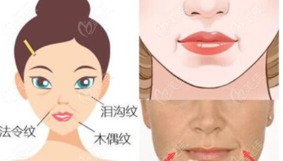 脸上的木偶纹怎么消除