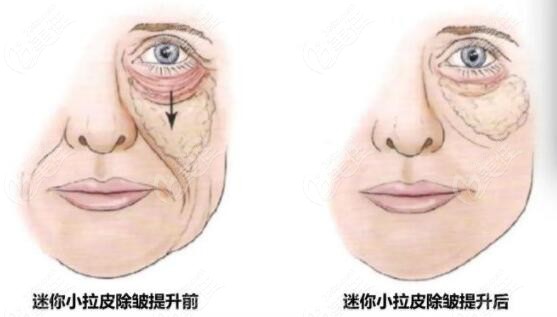 拉皮手术能解决改善木偶纹吗
