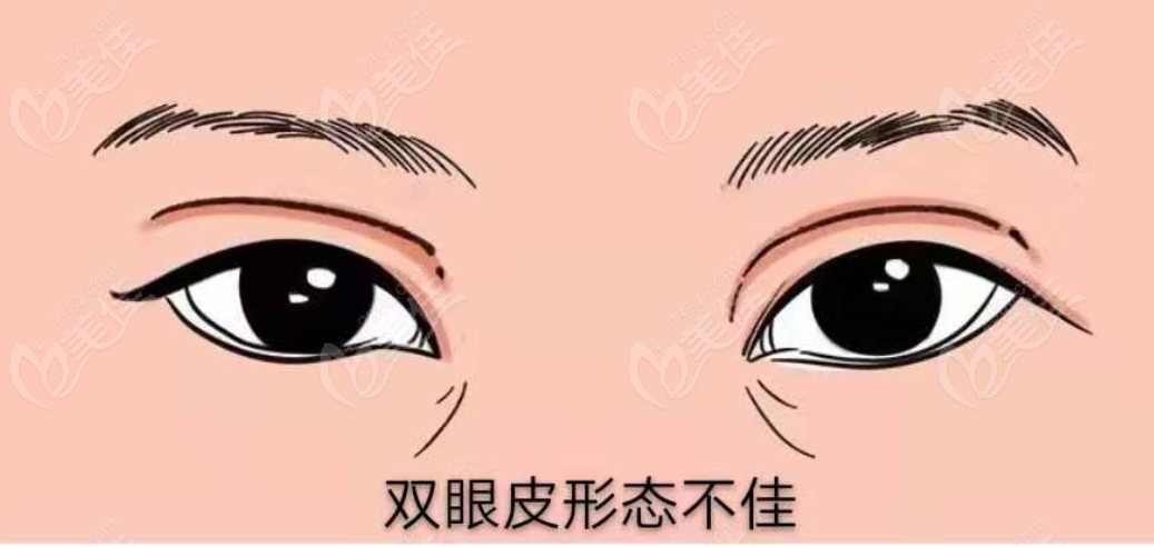 <!--<i data=20240703-sp></i>-->美莱吴海龙眼修复怎么样 <!--<i data=20240703-sp></i>-->美莱吴海龙眼修复怎么样