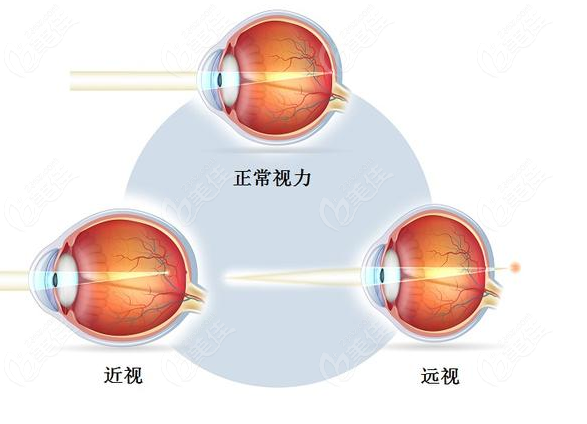 半飞秒和全飞秒区别 半飞秒和全飞秒区别