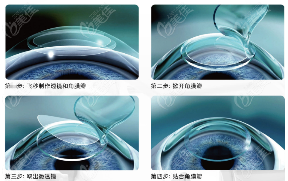 全飞秒手术步骤 全飞秒手术步骤