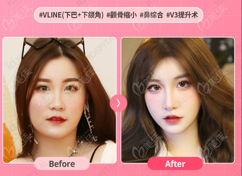 韩国id李知赫轮廓三件套对比照 韩国id李知赫轮廓三件套对比照