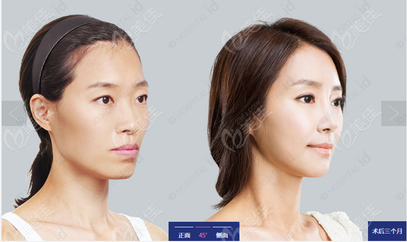 从实例看李知赫颧骨内推明显还不下垂 从实例看李知赫颧骨内推明显还不下垂