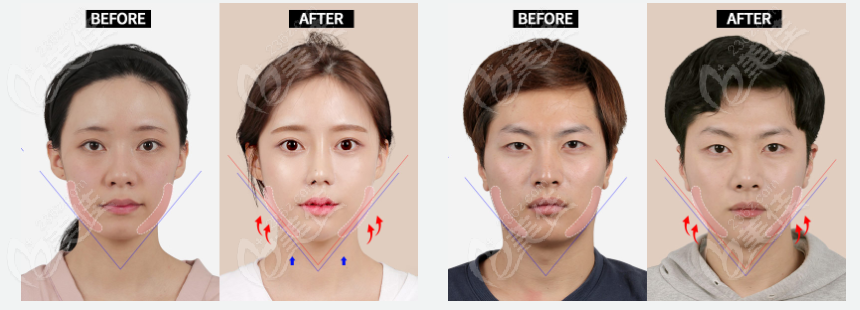 李知赫下颌角磨骨对比照看下颌角线条流畅比较自然m.236z.com 李知赫下颌角磨骨对比照看下颌角线条流畅比较自然m.236z.com