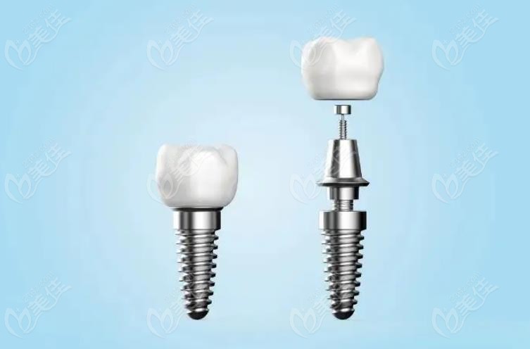 牙齿种植 牙齿种植