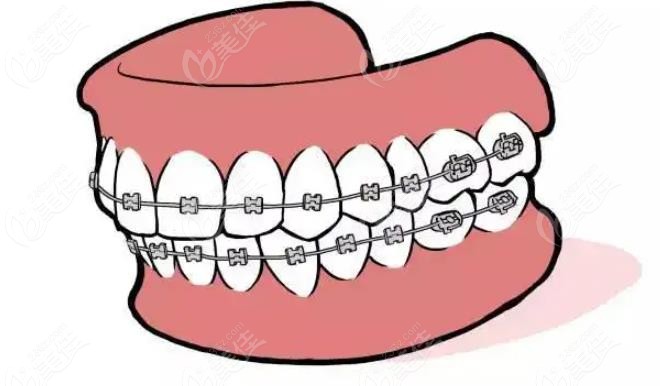 矫正牙齿 矫正牙齿