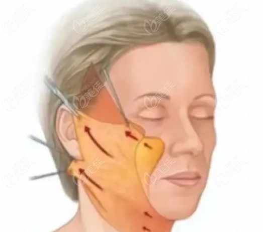 筋膜悬吊提升怎么做 筋膜悬吊提升怎么做