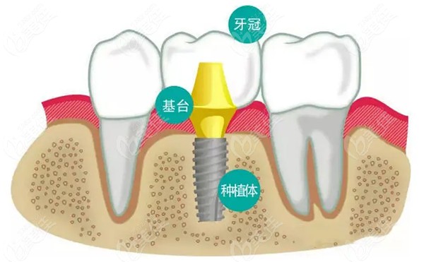 新疆乌鲁木齐种植牙价格表 新疆乌鲁木齐种植牙价格表