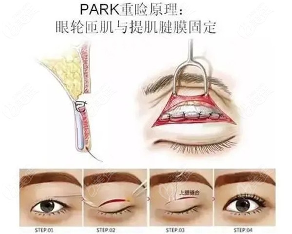 赤峰悦美整形做park法双眼皮的原理图