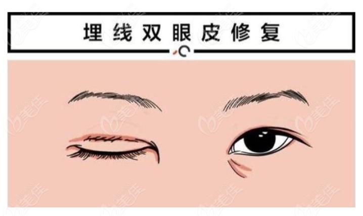 广州双眼皮修复专科医生