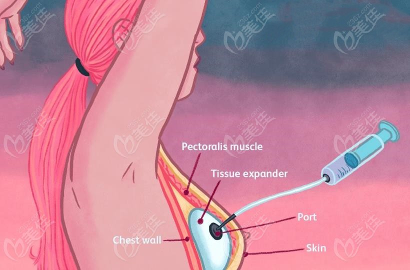 乳房重建手术注水过程图