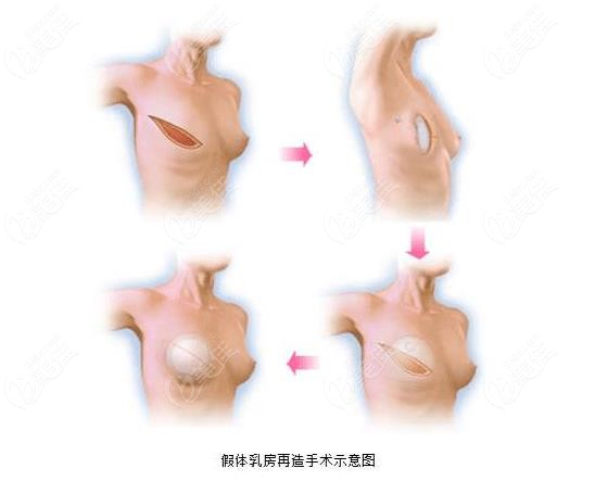 乳房重建手术过程图