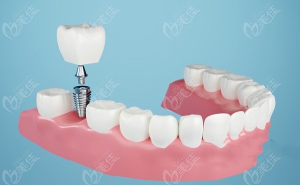 <!--<i data=20240703-sp></i>-->口腔种植牙 <!--<i data=20240703-sp></i>-->口腔种植牙