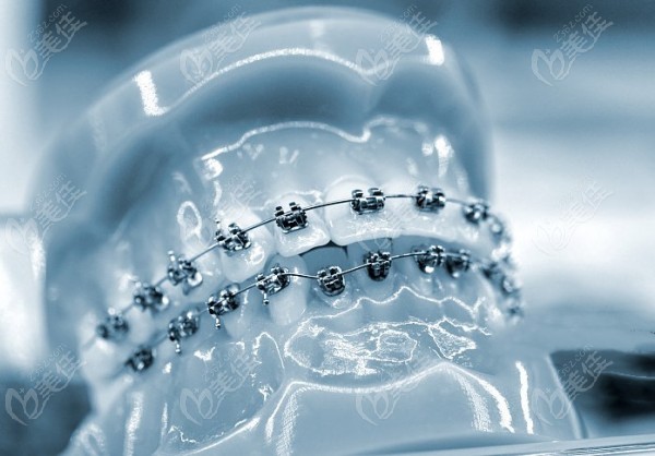 <!--<i data=20240703-sp></i>-->口腔牙齿矫正价格表 <!--<i data=20240703-sp></i>-->口腔牙齿矫正价格表