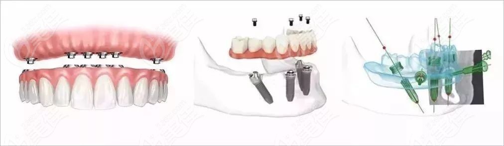 种植一口牙大概需要多少钱236z.com 种植一口牙大概需要多少钱236z.com