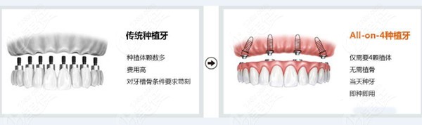安一口种植牙要多少钱?3.8-10万不等 安一口种植牙要多少钱?3.8-10万不等
