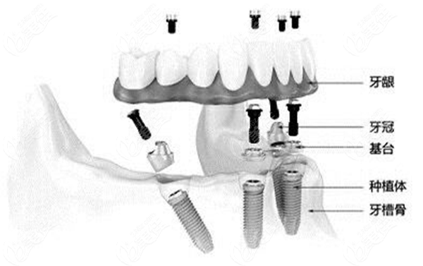 老人全口种植牙费用表 老人全口种植牙费用表