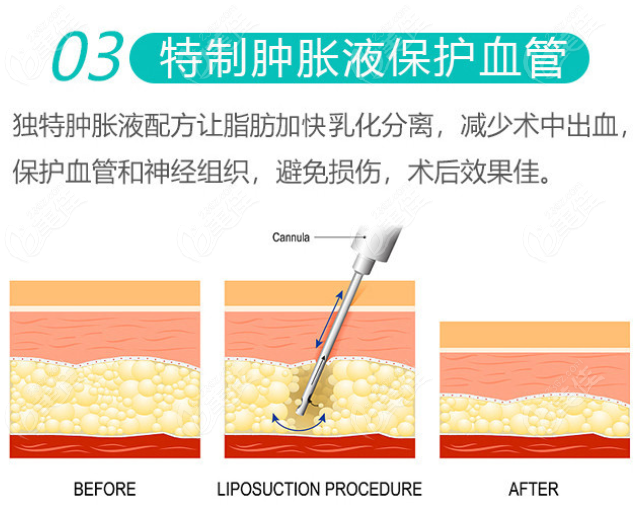 宋新医生吸脂多少钱www.236z.com 宋新医生吸脂多少钱www.236z.com