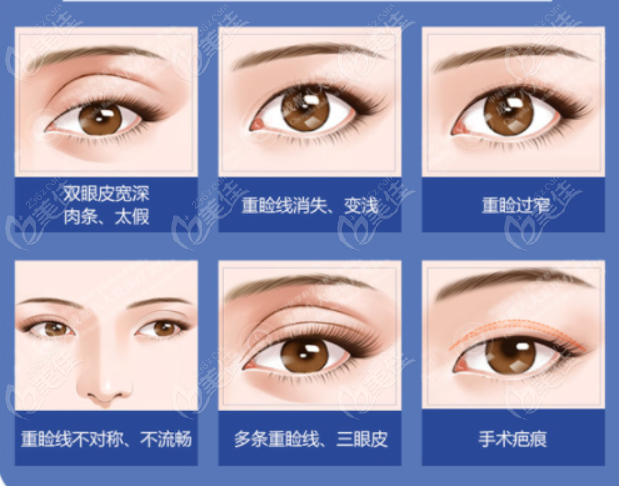 上海修复双眼皮的十大医生排名