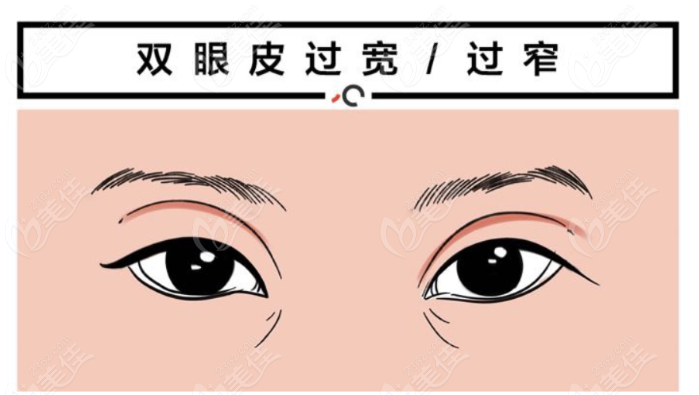上海时光余东医生修复双眼皮怎么样